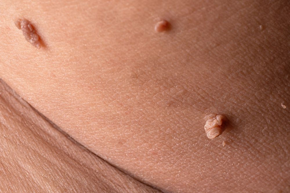 The difference between a wart and a skin tag.jpg.optimal