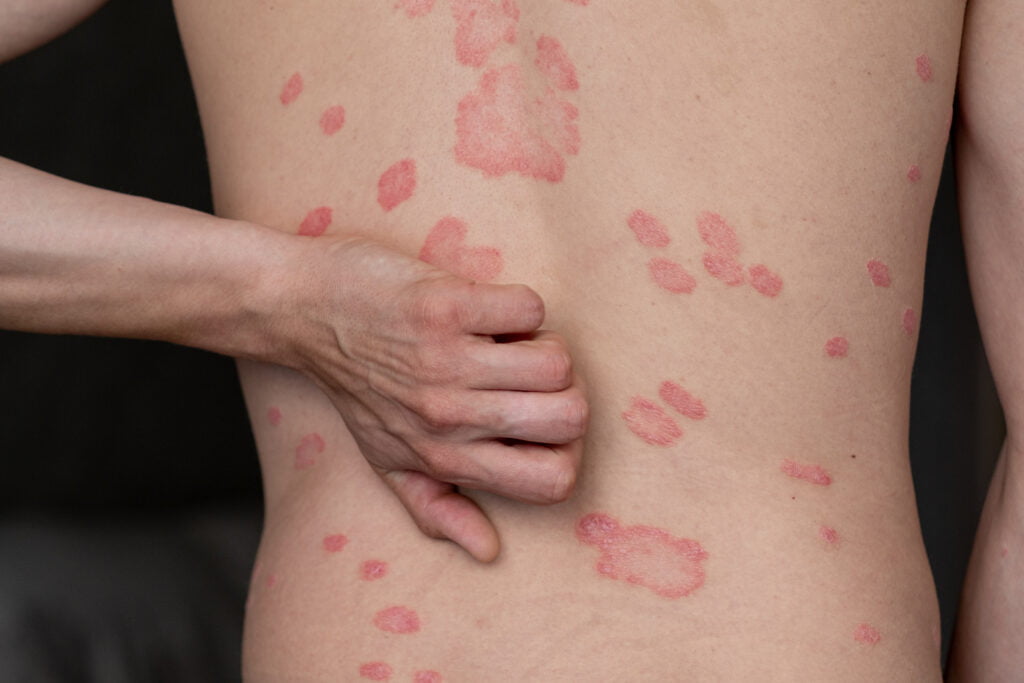 psoriasis uni klinik sri sendayan