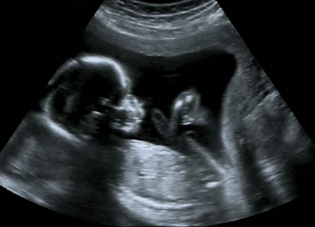 150323113024 four month ultrasound