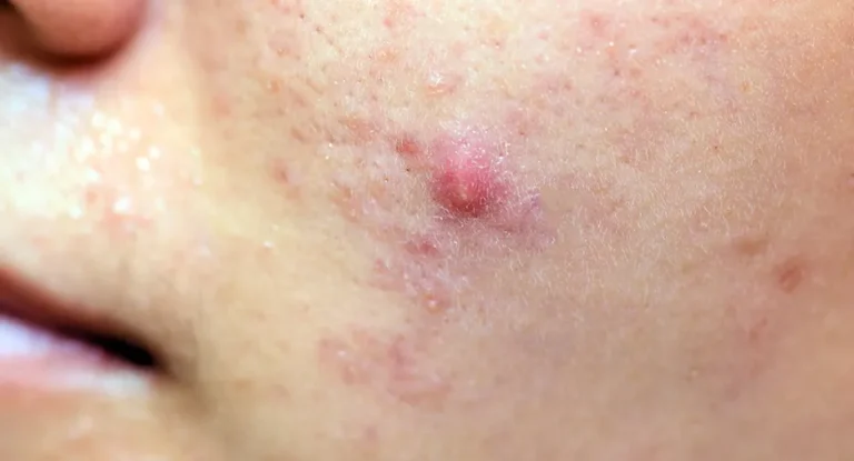 Papules 1 768x415 1