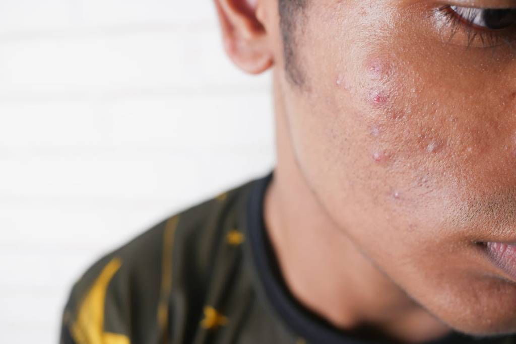 close up of young man face with skin problem 2024 12 10 04 28 59 utc