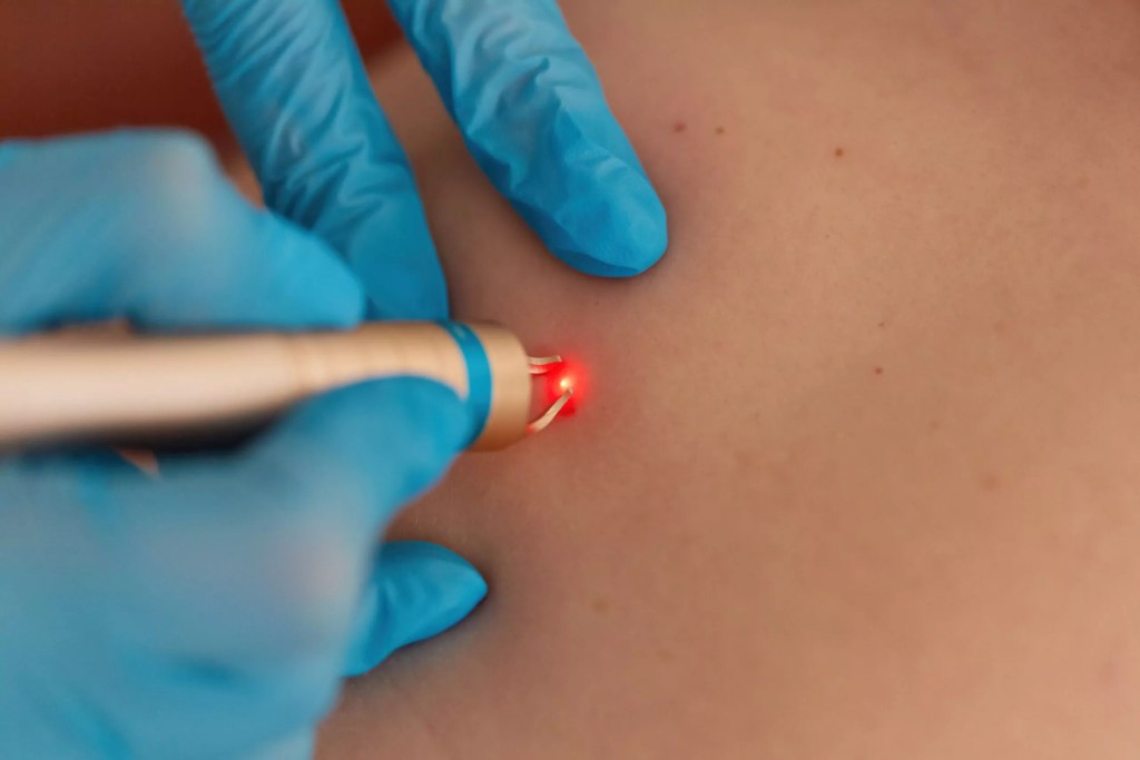 DrCindy blog laser skin tag removal scaled 1