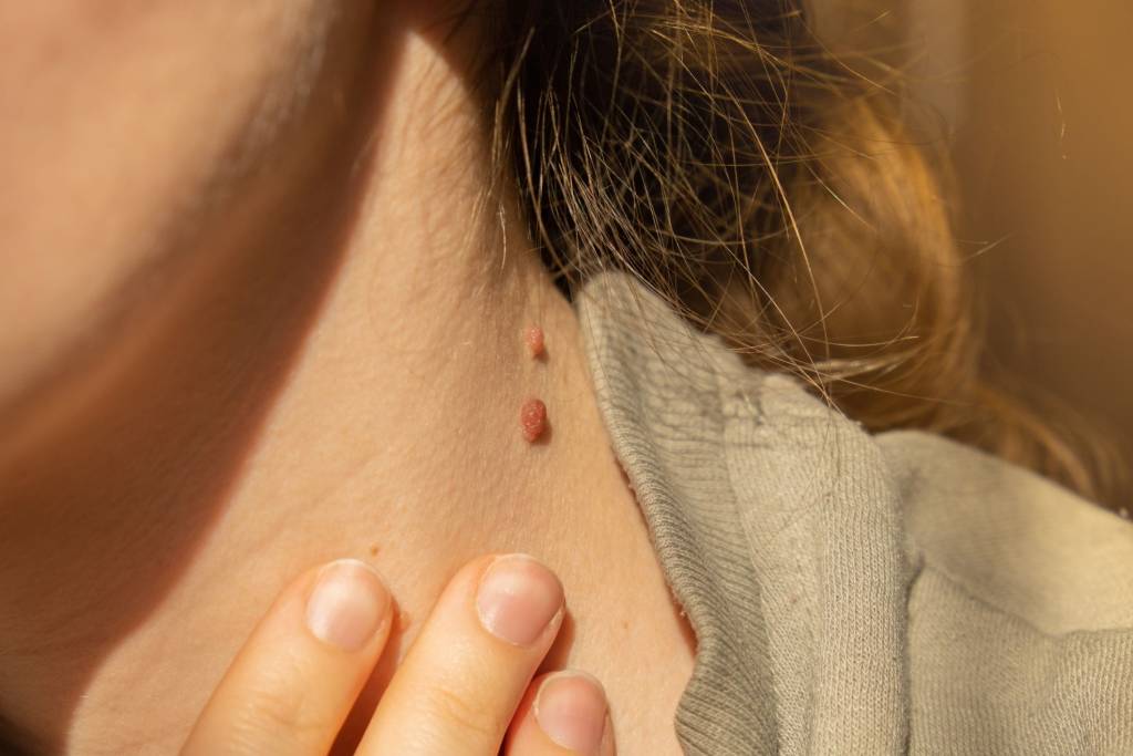 birthmarks on skin close up detail of the bare skin royalty free image 1660769462