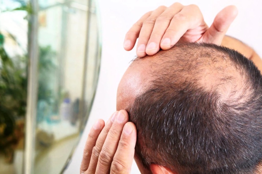 alopecia male hair loss 1