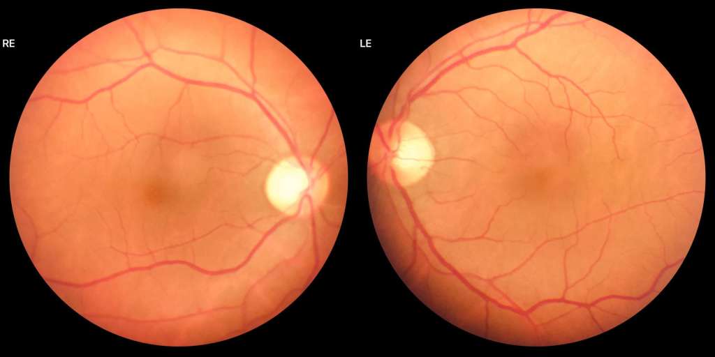 fundus exam image example