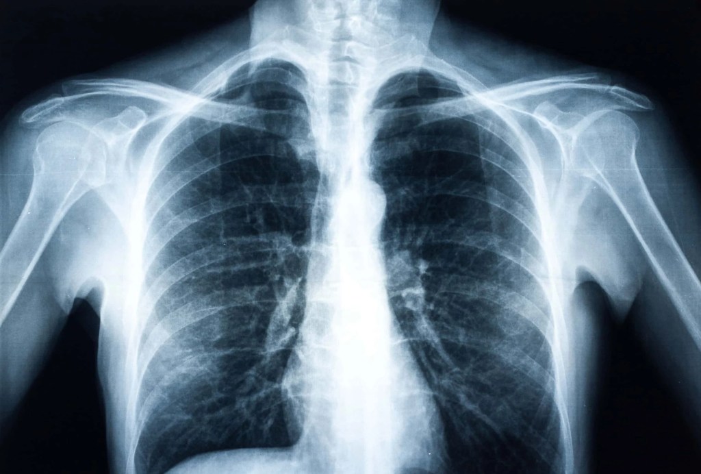 chest xray